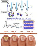 Dispositivo para Tratamento de Unhas com Luz Infravermelha Unhamax® |COMPRE 2 LEVE 3| + Frete Grátis