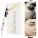 Removedor de Verrugas Laser - SkinClear Plus®