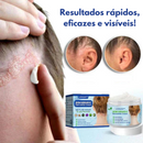 Creme para Tratamento Contra Caspas e Dermatite - CleanCasp