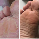 Anti Fungos Chulé Frieira Furzero™ Spray |COMPRE 1 LEVE 2| + Frete Grátis