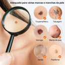 Removedor de Verrugas Laser - SkinClear Plus®