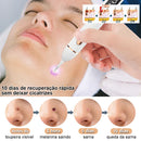 Removedor de Verrugas Laser - SkinClear Plus®
