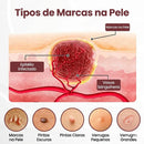 Adeus Verrugas: Creme VERRUE [COMPRE 1 LEVE 2] + Frete Grátis